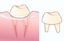 ファイバーコア