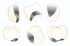 メタルボンドクラウン