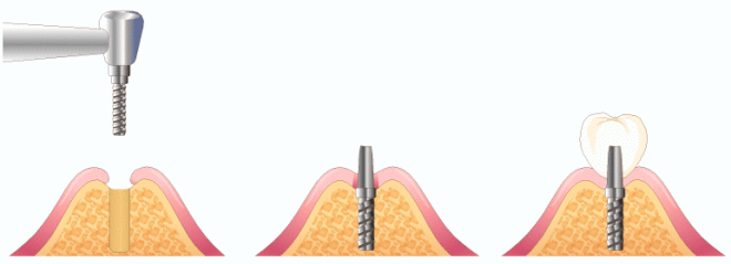 インプラント一回法