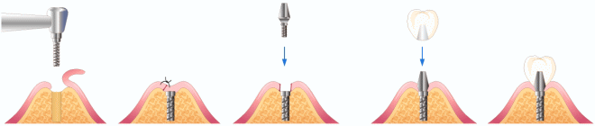 インプラント二回法